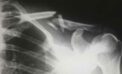 broken collarbone bone x-ray medical ConnecTour Chronicles: Learning to roll with one of this tour’s unexpected twists